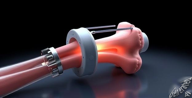 Un dispositivo portátil que realiza injertos directamente sobre fracturas